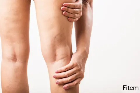 Une femme se tient la jambe, ressentant une courbature. Des varicosités sont visibles sur sa peau.