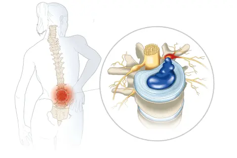 Illustration d'une discopathie lombaire causant une douleur la nuit, avec un disque intervertébral hernié comprimant un nerf.
