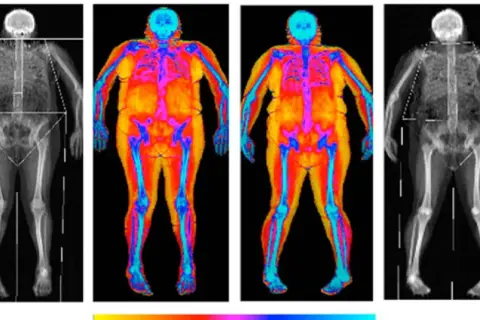 Radiographies et thermographies corporelles montrant une transformation : je m'affine mais je prends du poids. Les couleurs chaudes indiquent la graisse, les bleues les os.