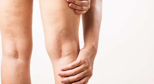 Une femme se tient la jambe, ressentant une courbature. Des varicosités sont visibles sur sa peau.